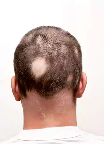 Hair Loss Treatment for Men in Gurgaon