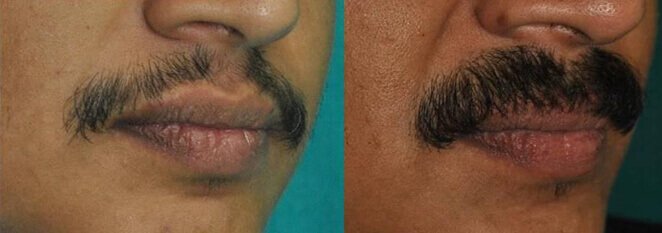 Moustache Transplant in Gurgaon