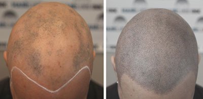 Scalp Micropigmentation- Scarring Alopecia
