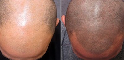 Scalp Micropigmentation For Baldness